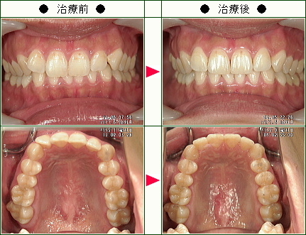 歯のデコボコ矯正症例(カオル様　２８歳　女性)