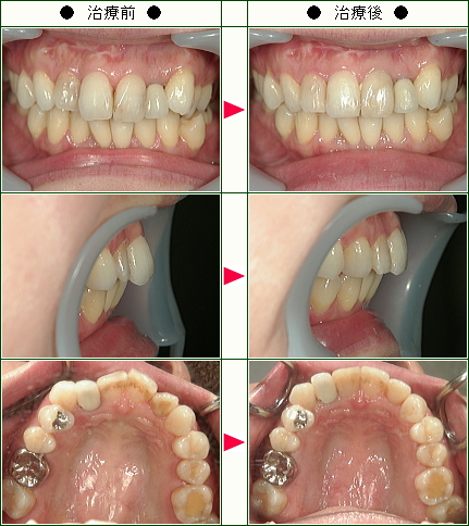 歯のデコボコ矯正症例(片桐様　３４歳　女性)