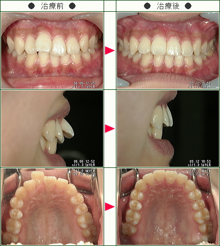 歯のデコボコ矯正症例(加藤様　２３歳　女性)