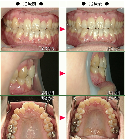歯のデコボコ矯正症例(川田様　３９歳　女性)