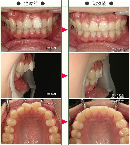 歯のデコボコ矯正症例(河野様　２７歳　女性)