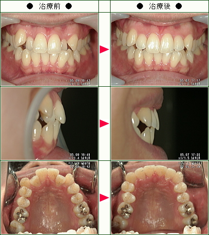 歯のデコボコ矯正症例(川﨑様　３４歳　女性)
