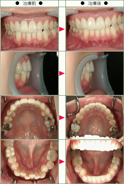 歯のデコボコ矯正症例(Ｋａｚｕ様　３６歳　女性)