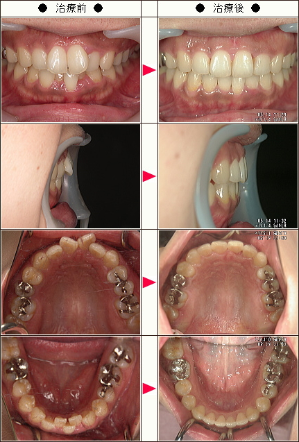 歯のデコボコ矯正症例［Kazu様　女性］