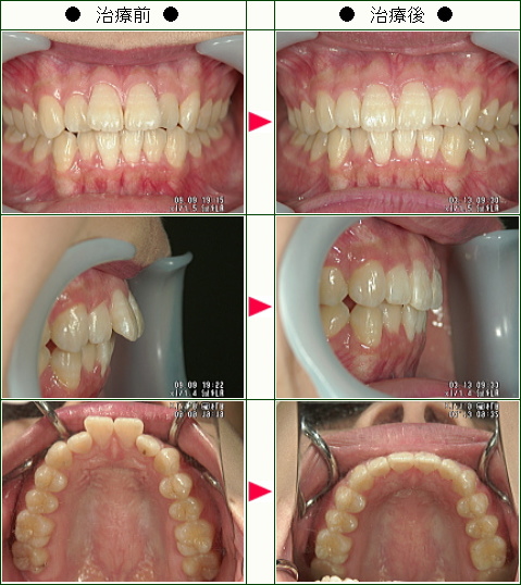 出っ歯矯正症例(Ｋ.Ｃ様　１９歳　女性)