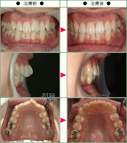 歯のデコボコ矯正症例(Ｋ・Ｅ様　２９歳　女性)