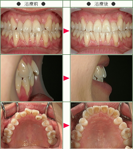 歯のデコボコ矯正症例(Ｋｅｉｋｏ様　３５歳　女性)