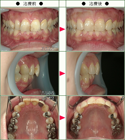 歯のデコボコ矯正症例(Ｋ.Ｈ様　３２歳　女性)