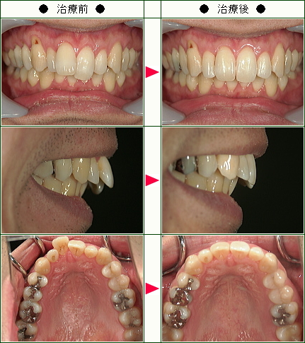 歯のデコボコ矯正症例(Ｋ.Ｉ様　３３歳　男性)