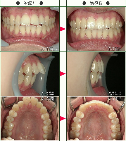 出っ歯矯正症例(木原様　２３歳　女性)