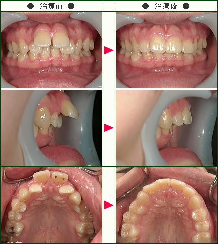 出っ歯矯正症例(木村様　２７歳　女性)