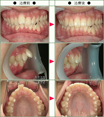 出っ歯矯正症例(Ｋ.Ｋ様　１７歳　女性)