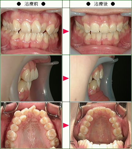 歯のデコボコ矯正症例(Ｋ・Ｋ様　２０歳　女性)
