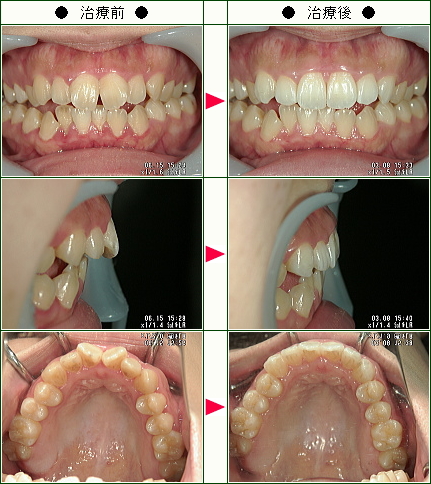 歯のデコボコ矯正症例(Ｋ.Ｋ様　２５歳　女性)