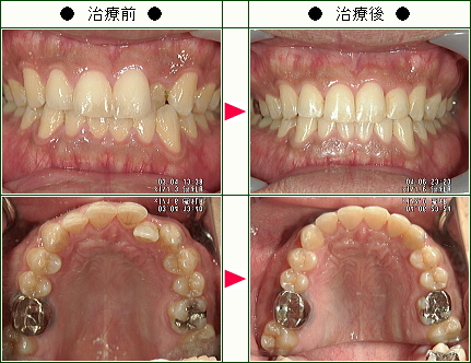 歯のデコボコ矯正症例(ＫＫ様　２５歳　男性)