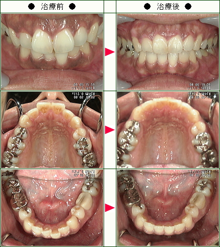 歯のデコボコ矯正症例(Ｋ.Ｋ様　２８歳　女性)