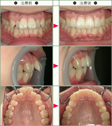 出っ歯矯正症例(Ｋ.Ｋ様　３１歳　女性)