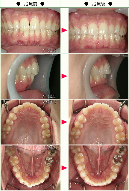 歯のデコボコ矯正症例(Ｋ・Ｋ様　３２歳　男性)
