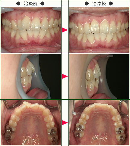 歯のデコボコ矯正症例(Ｋ.Ｋ様　３９歳　女性)