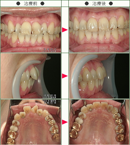 歯のデコボコ矯正症例(Ｋ．Ｋ様　４１歳　女性)