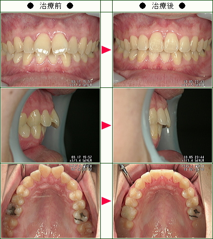 歯のデコボコ矯正症例(Ｋ．Ｍ様　２１歳　男性)
