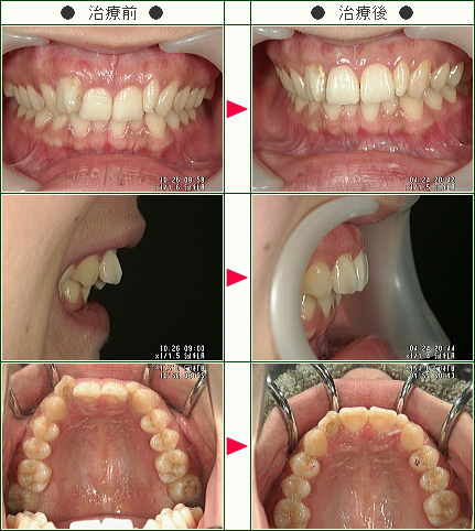 歯のデコボコ矯正症例(Ｋ．Ｍ．様　２４歳　女性)