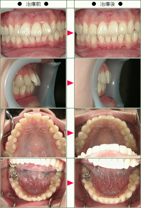 出っ歯矯正症例(ＫＭ様　２４歳　女性)