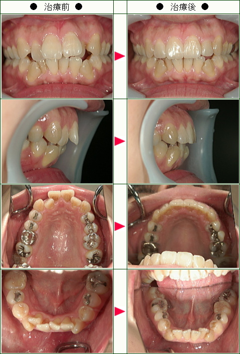 歯のデコボコ矯正症例(Ｋ・Ｍ様　３１歳　女性)