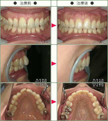 歯のデコボコ矯正症例(Ｋ.Ｍ様　４５歳　女性)