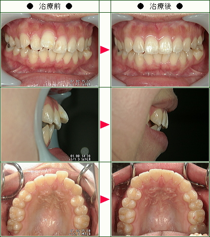 歯のデコボコ矯正症例(Ｋ.Ｎ様　２３歳　女性)