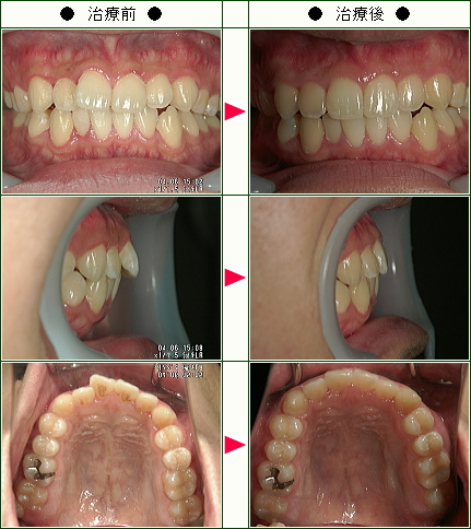 歯のデコボコ矯正症例(Ｋ．Ｎ様　２６歳　男性)
