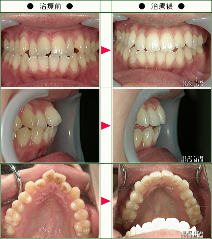 歯のデコボコ矯正症例(Ｋ.Ｎ様　２８歳　女性)
