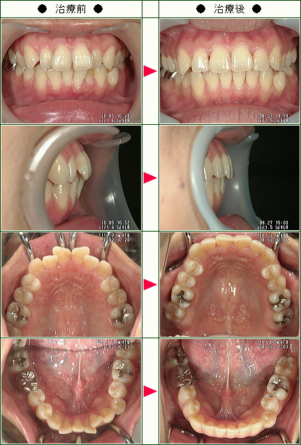 歯のデコボコ矯正症例(Ｋ・Ｎ様　２９歳　女性)