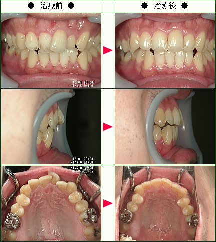 歯のデコボコ矯正症例(Ｋ．Ｎ様　２９歳　男性)