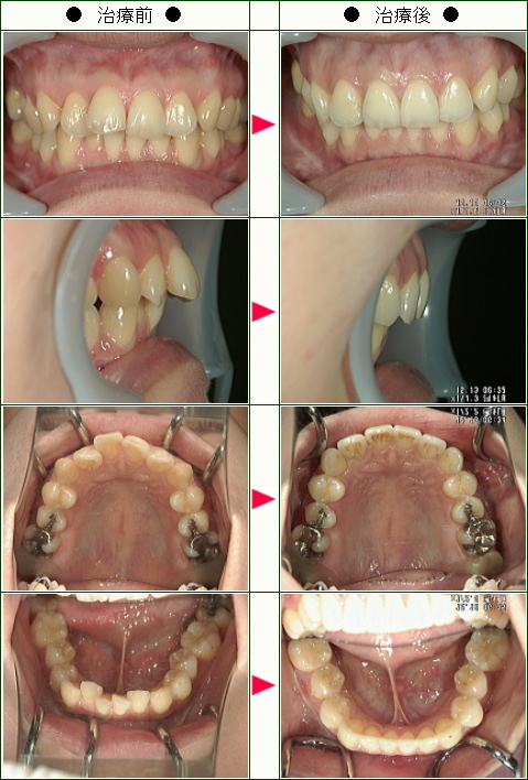 出っ歯矯正症例(Ｋ.Ｎ様　３１歳　女性)