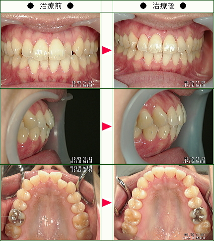 歯のデコボコ矯正症例(Ｋ.Ｎ様　３５歳　女性)