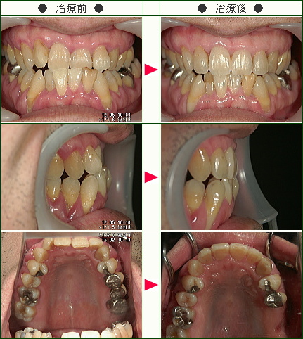 歯のデコボコ症例(Ｋ．Ｎ様　４６歳　男性)