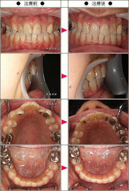 歯のデコボコ矯正症例［Ｋ．Ｏ様　２４歳　女性］