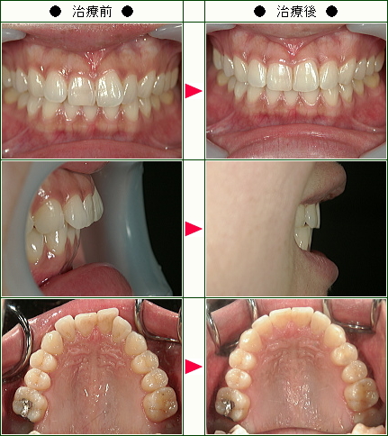 出っ歯矯正症例(Ｋ．Ｏ様　２６歳)
