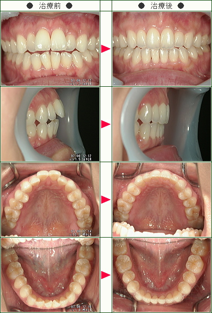 出っ歯矯正症例(Ｋ.Ｏ様　２９歳　女性)