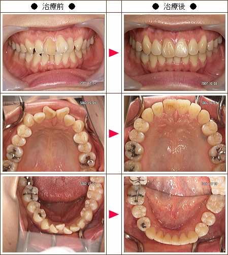 歯のデコボコ矯正症例［Ｋ．Ｏ．様　３８歳　女性］