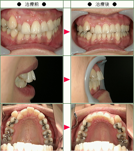 歯のデコボコ矯正症例(小橋様　４０歳　女性)