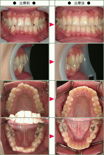 歯のデコボコ矯正症例(小林様　２２歳　女性)