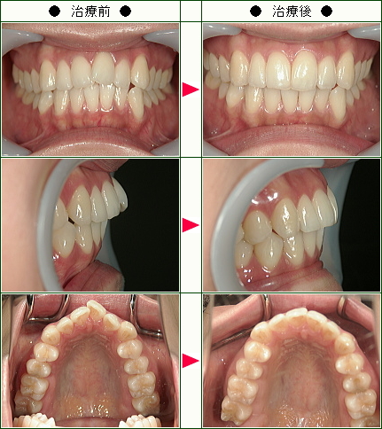 出っ歯矯正症例(コバヤシ様　２６歳　女性)