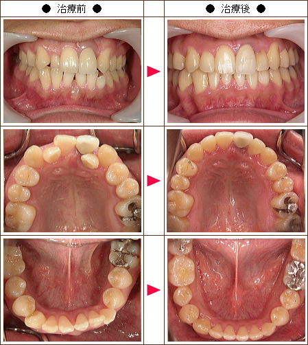 歯のデコボコ矯正症例［小林様　２７歳　男性］