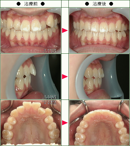 歯のデコボコ矯正症例(小堀様　１８歳　女性)