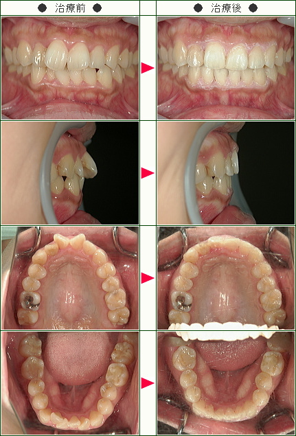 出っ歯矯正症例(コダイラ様　２７歳　女性)