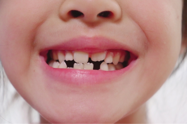 子供の矯正で抜歯後によくある症状