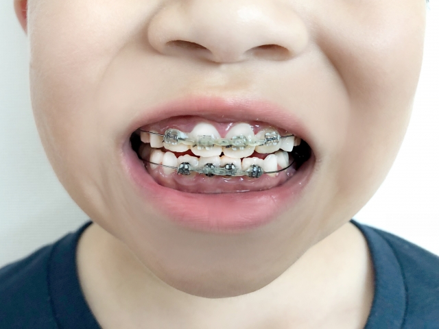 子どもの歯科矯正の治療方法