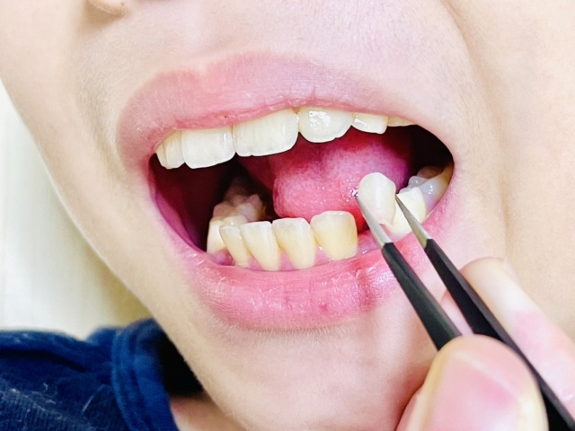 歯列矯正で抜歯を避けたい人は多い